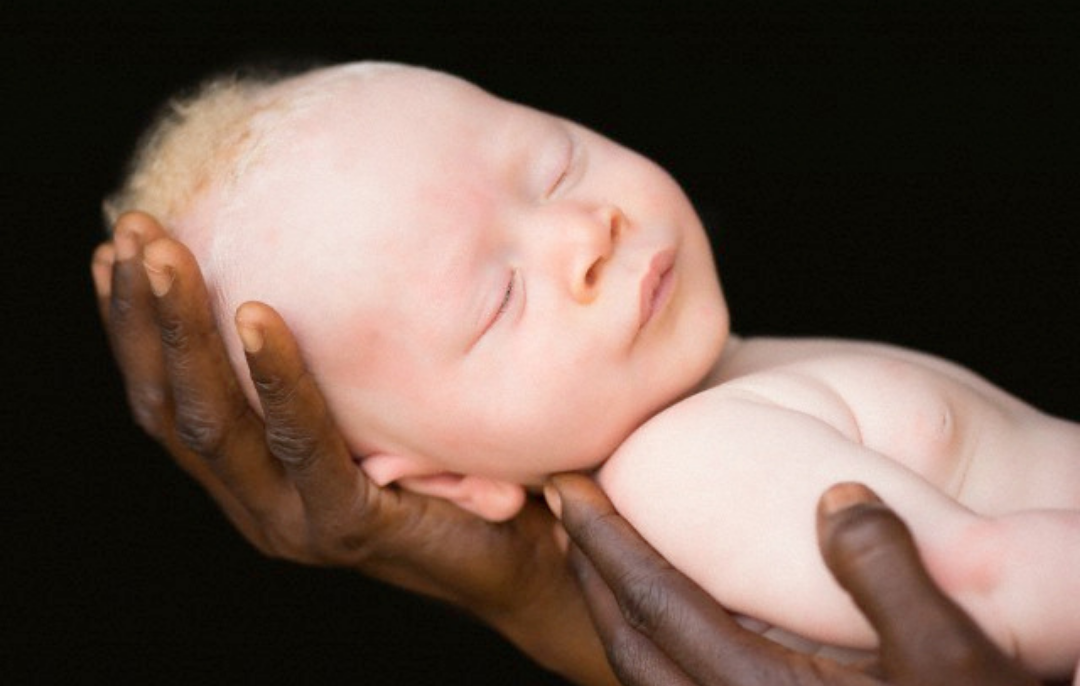 Aprenda como cuidar da pele de um albino